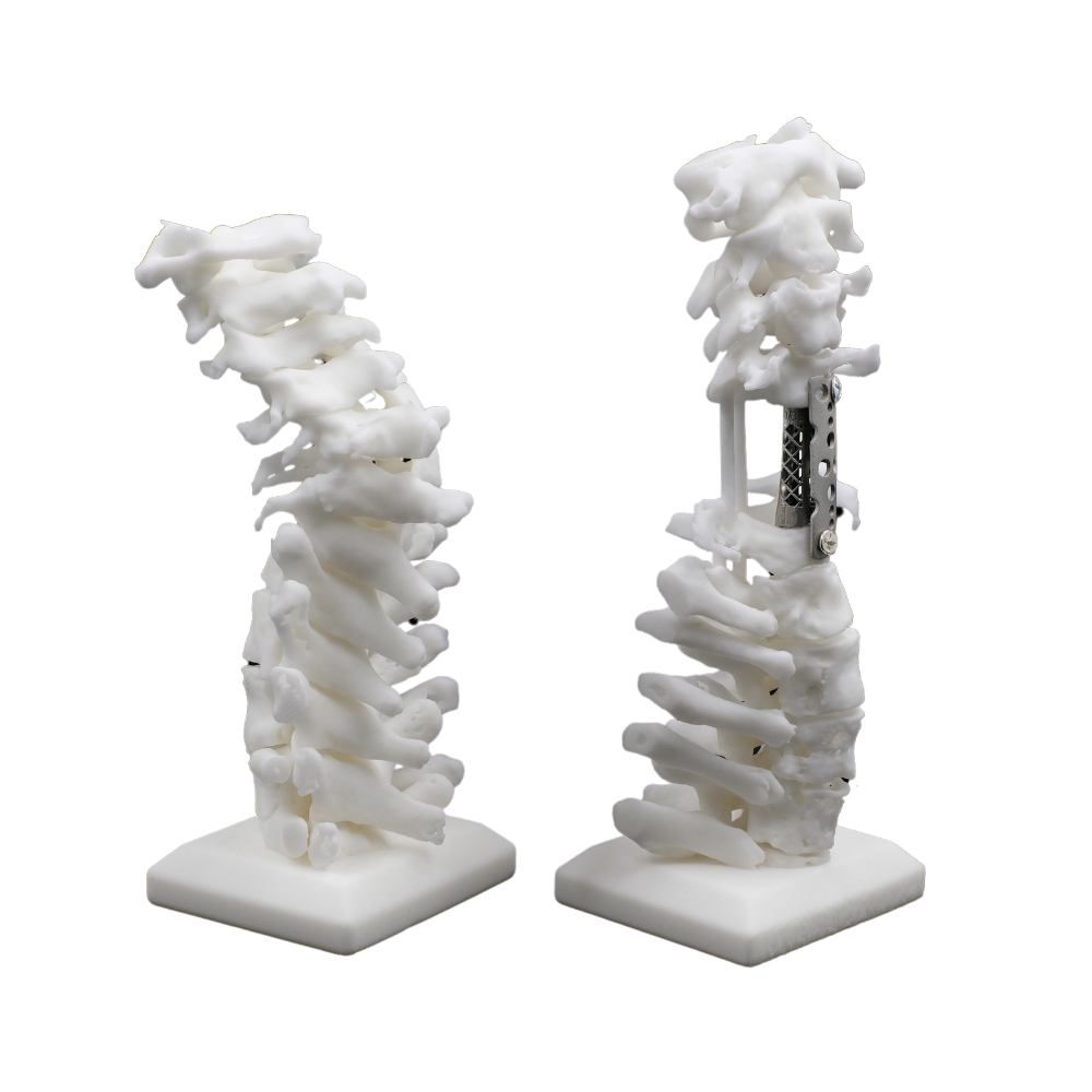 3D printed metal implant