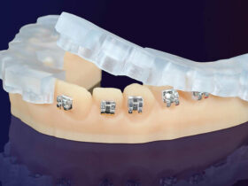 KeyOrtho-IBT-Dental-Material