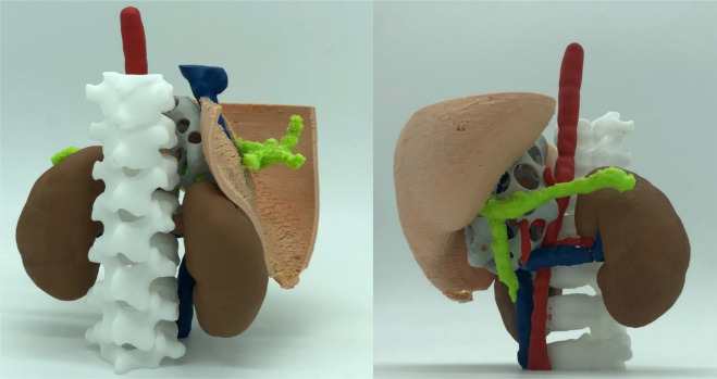 3d-printed-human-organ-model Surgical Planning and Simulation