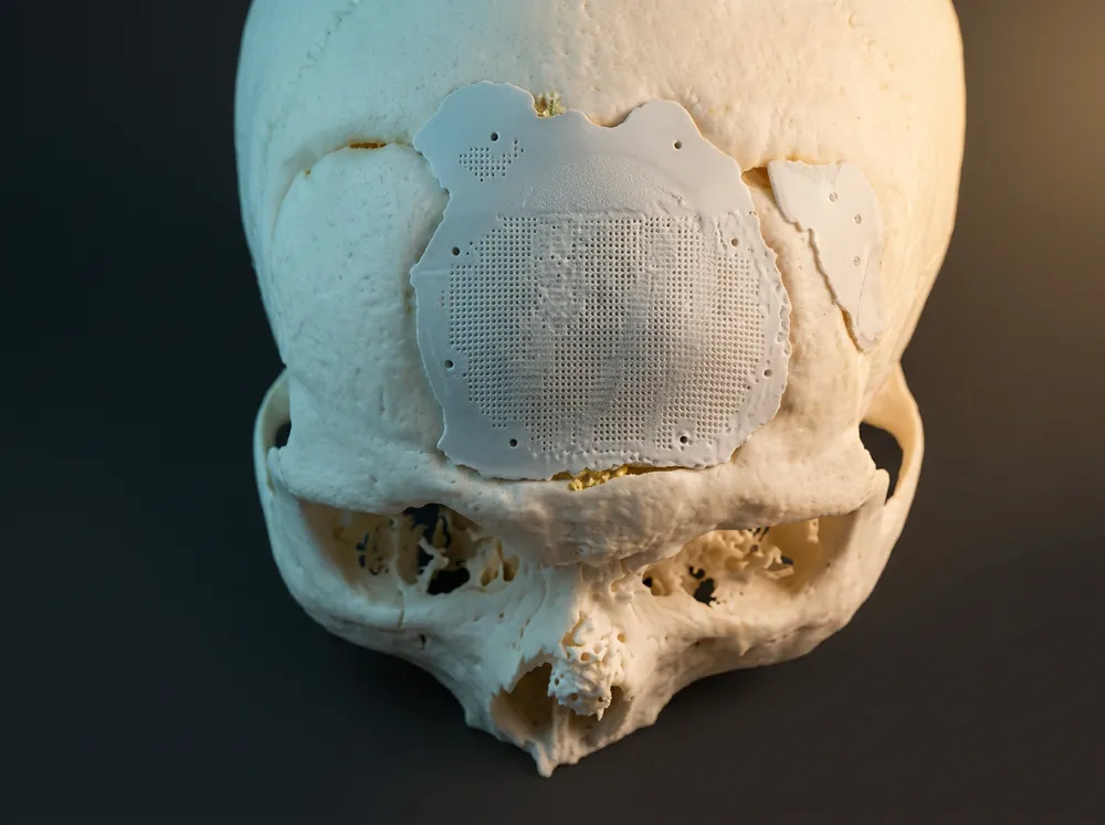 White SLA resin anatomical model for surgical planning